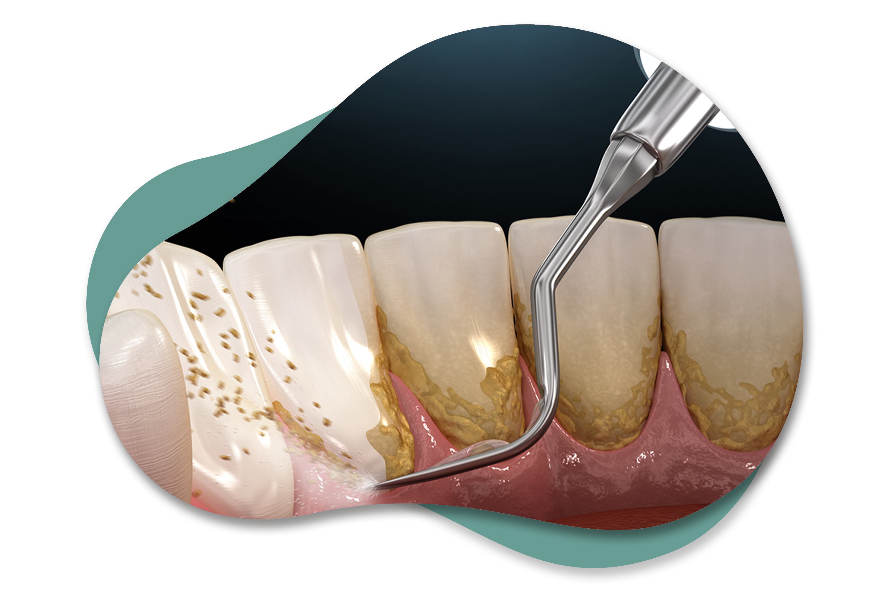 Periodontal Tedaviler
